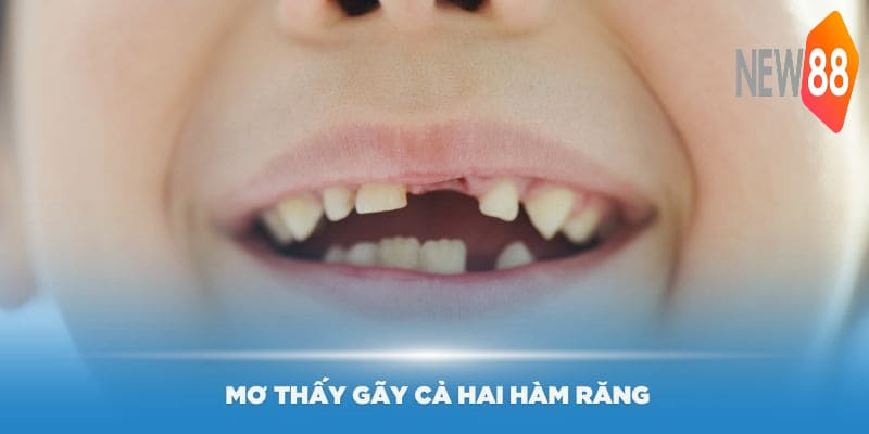 Trường hợp mơ thấy gãy cả hai hàm răng